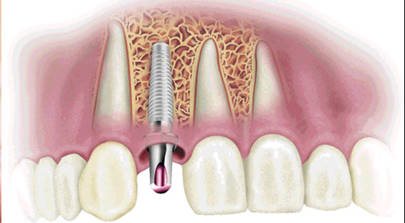 cirurgia-implante