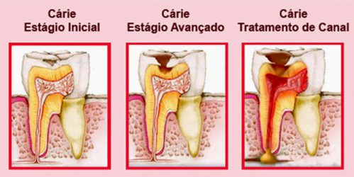 C rie Dent ria Cl nica Odontol gica BH C rie Dent ria Cl nica Odontol gica BH