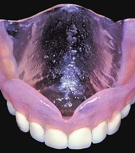 Prótese dentária: tudo o que você precisa saber