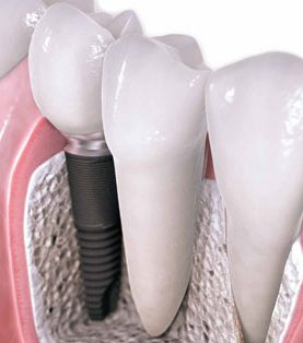 Quais São os Tipos de Enxerto Ósseo para Implantes Dentários?